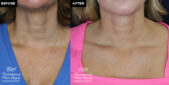 Radiesse injection before and after results at Contemporar Plastic Surgery