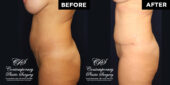 tummy tuck patient