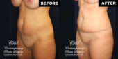 tummy tuck patient