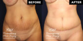 tummy tuck patient