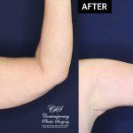upper arm lift surgery before and after results at Contemporary Plastic Surgery