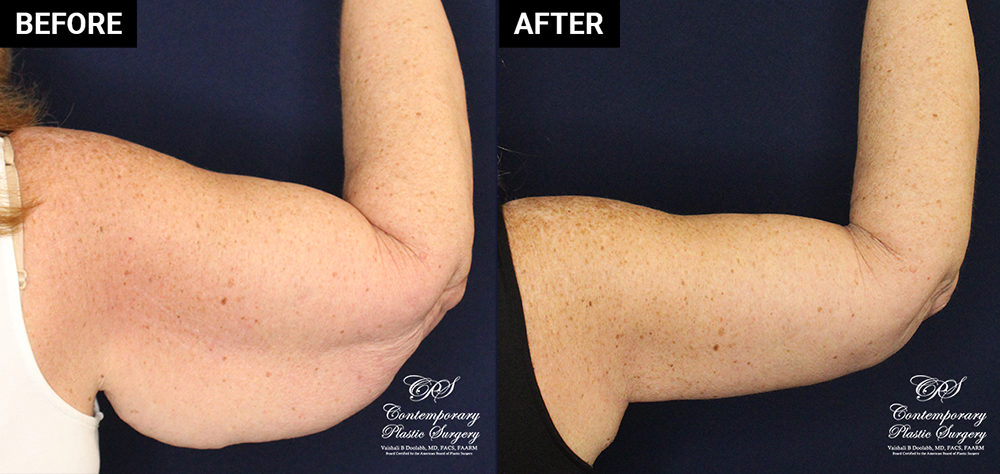Arm lift patient results at Contemporary Plastic Surgery