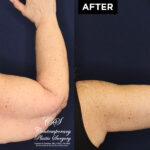 upper arm lift patient results at Contemporary Plastic Surgery