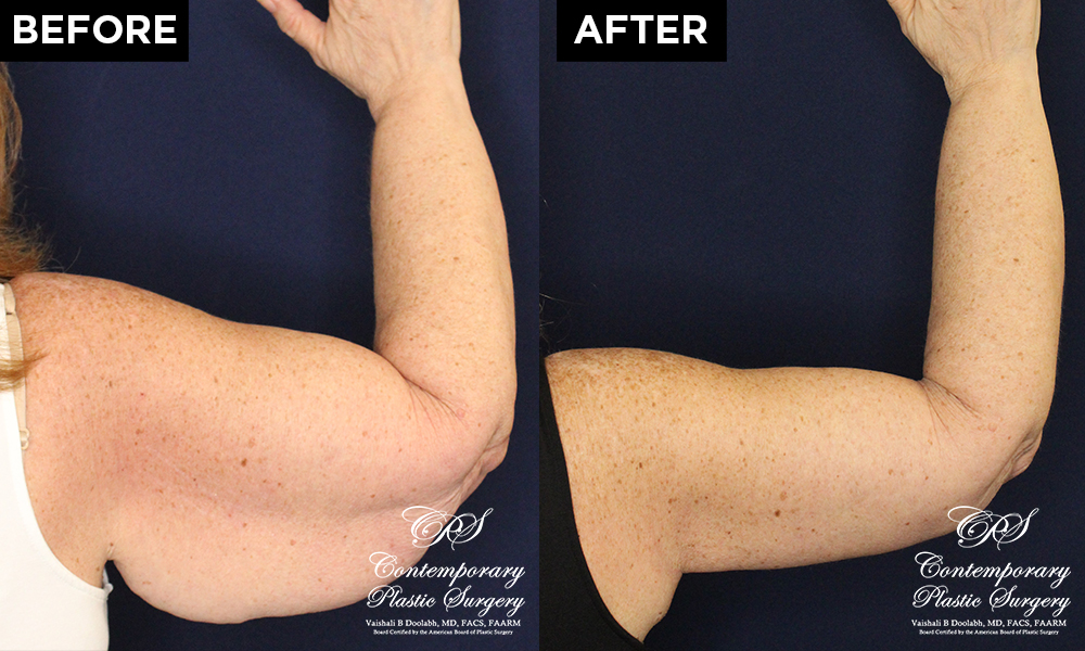 upper arm lift patient results at Contemporary Plastic Surgery