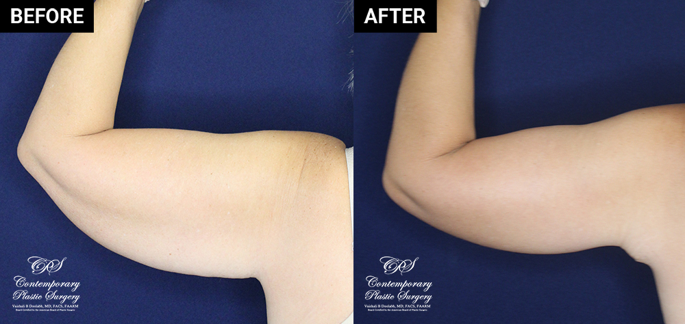 upper arm lift patient before and after results at Contemporary Plastic Surgery