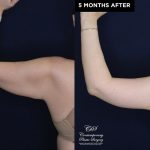 Patient 20074's arm lift before and after results at Contemporary Plastic Surgery