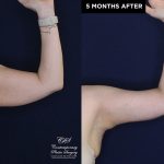Patient 20074's arm lift before and after results at Contemporary Plastic Surgery