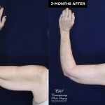 upper arm lift patient 20557 before and after results at Contemporary Plastic Surgery