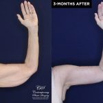upper arm lift patient 20557 before and after results at Contemporary Plastic Surgery
