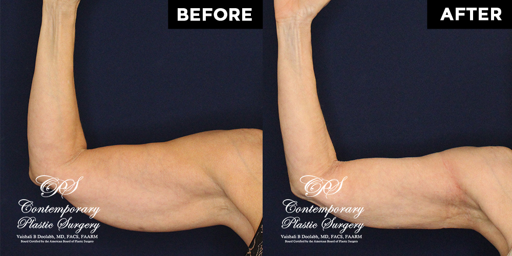 60 y.o woman desired arm contouring without lengthy scars. She underwent VASER liposuction with Renuvion skin tightening through portal sites