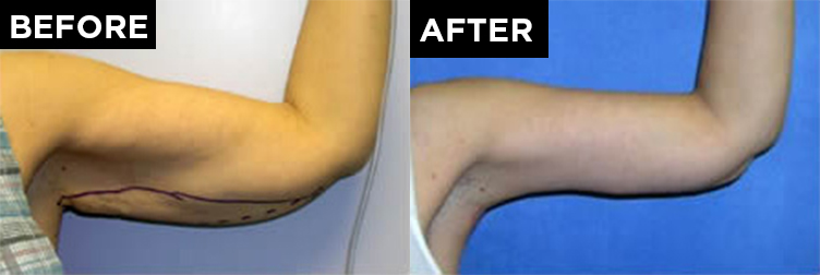 patient arm before arm lift proceudure