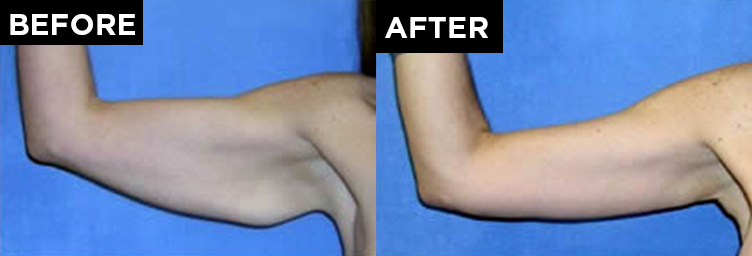 patient arm before arm lift procedure