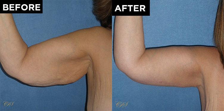 patient arm before & after arm lift