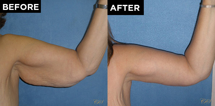 patient arm before & after arm lift