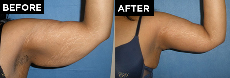 patient arm before and after arm lift procedure