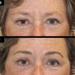 eyebrow micropigmentation patient 19993 before and after results at Contemporary Plastic Surgery