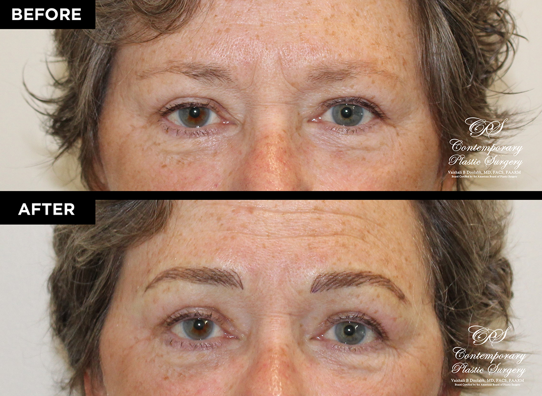eyebrow micropigmentation patient 19993 before and after results at Contemporary Plastic Surgery