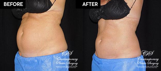 Patient's before and after results from CoolSculpting treatment at Contemporary Plastic Surgery