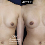fat transfer patient results at Contemporary Plastic Surgery