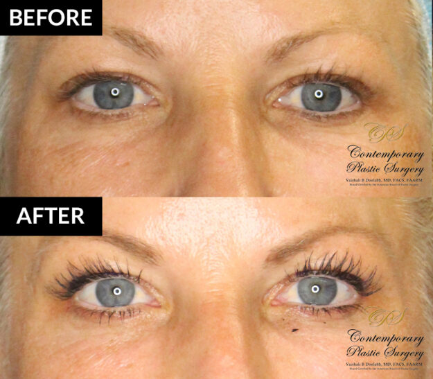 Patient 18264's before and after results from microfat transfer at Contemporary Plastic Surgery