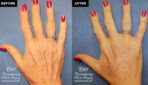 patient results before & after Radiesse injections at Contemporary Plastic Surgery