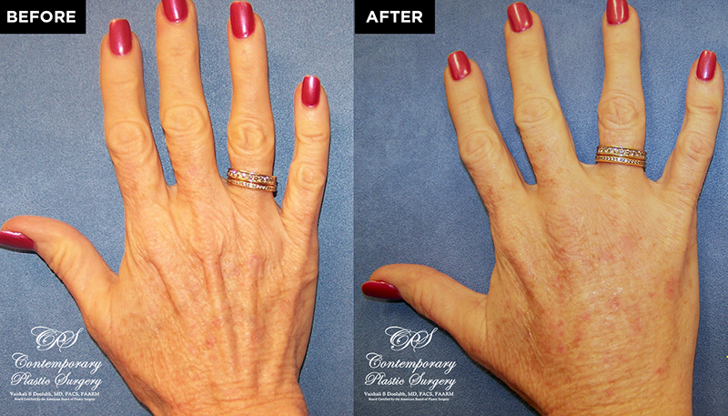 patient results before & after Radiesse injections at Contemporary Plastic Surgery