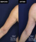 patient before & after Radiesse injections at Contemporary Plastic Surgery