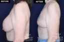 Patient 10192 before and after implant removal and breast lift results at Contemporary Plastic Surgery