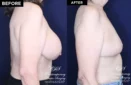Patient 10192 before and after implant removal and breast lift results at Contemporary Plastic Surgery