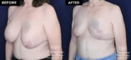 Patient 10192 before and after implant removal and breast lift results at Contemporary Plastic Surgery