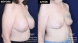 Patient 10192 before and after implant removal and breast lift results at Contemporary Plastic Surgery