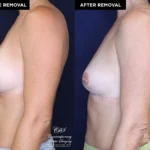 Patient 13478 breast implant removal with replacement at Contemporary Plastic Surgery