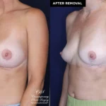 Patient 13478 breast implant removal with replacement at Contemporary Plastic Surgery