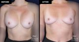 breast implant removal without replacement at Contemporary Plastic Surgery