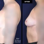breast implant removal without replacement at Contemporary Plastic Surgery