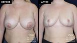 breast implant removal with replacement at Contemporary Plastic Surgery