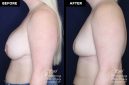 breast implant removal with replacement at Contemporary Plastic Surgery