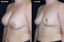 breast implant removal with replacement at Contemporary Plastic Surgery