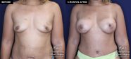 Patient 18489 breast augmentation before and after results at Contemporary Plastic Surgery
