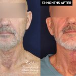 Patient 18982 neck lift before and after results at Contemporary Plastic Surgery