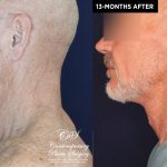 Patient 18982 neck lift before and after results at Contemporary Plastic Surgery