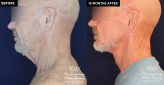 Patient 18982 neck lift before and after results at Contemporary Plastic Surgery