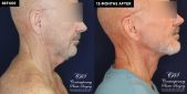 Patient 18982 neck lift before and after results at Contemporary Plastic Surgery