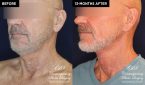 Patient 18982 neck lift before and after results at Contemporary Plastic Surgery