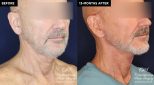 Patient 18982 neck lift before and after results at Contemporary Plastic Surgery