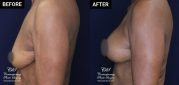 patient 20558 breast augmentation results at Contemporary Plastic Surgery