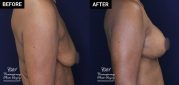 patient 20558 breast augmentation results at Contemporary Plastic Surgery