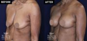 patient 20558 breast augmentation results at Contemporary Plastic Surgery