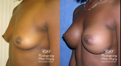 Patient #018’s Breast Augmentation at Jacksonville plastic surgery clinic, Contemporary Plastic Surgery