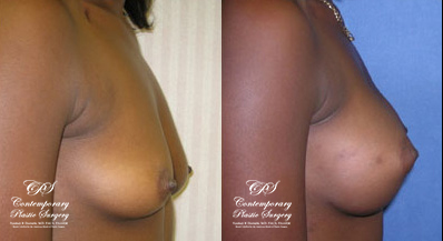 Patient #018’s Breast Augmentation at Jacksonville plastic surgery clinic, Contemporary Plastic Surgery